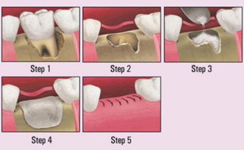 các-bước-ghép-xương-cho-răng