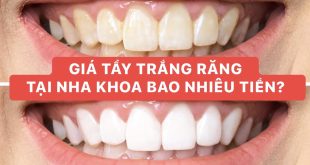 gia-tay-trang-rang-tai-nha-khoa-bao-nhieu