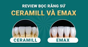 review-rang-su-ceramill-va-emax