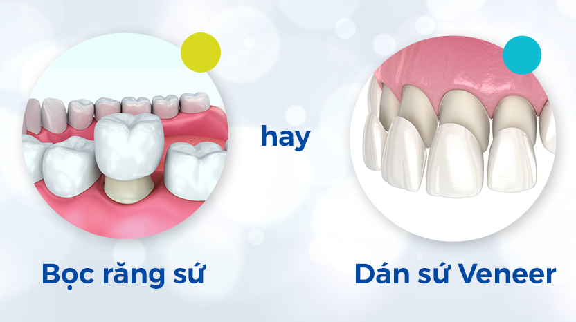 Nên bọc răng sứ hay dán veneer?