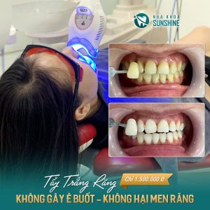 Giá tẩy trắng răng nha khoa Sunshine
