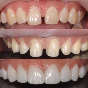 dan-su-veneer-co-tot-khong