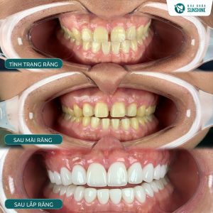 dan-su-veneer