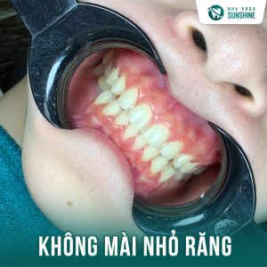 dan-rang-co-can-mai-rang-khong